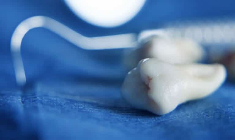 Wisdom Teeth Emerging? Here’s What You Should Know!