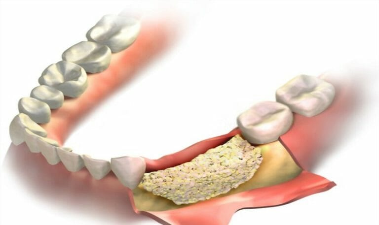 Featured image for “Dental Bone Grafting: Everything You Should Know”