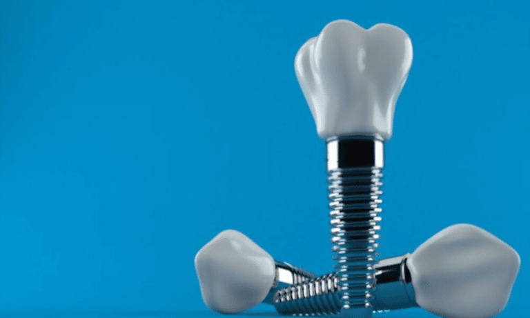Featured image for “How Are Dental Implants Beneficial For Your Oral Health?”