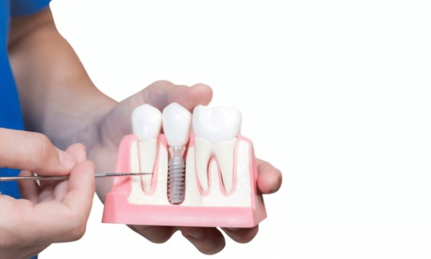 Dental implants in Beverly Hills