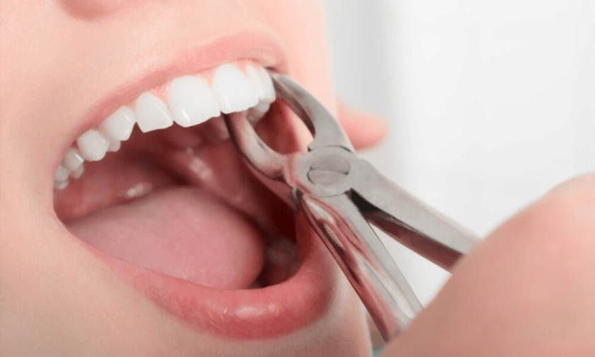 Tooth Extraction in Beverly Hills