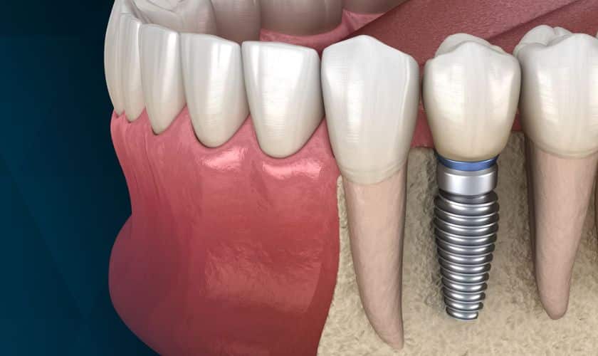 Featured image for “How Long Does it Take for Dental Bone Graft to Heal?”