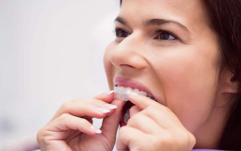 Featured image for “Invisalign Treatment 101: Everything You Need to Know”